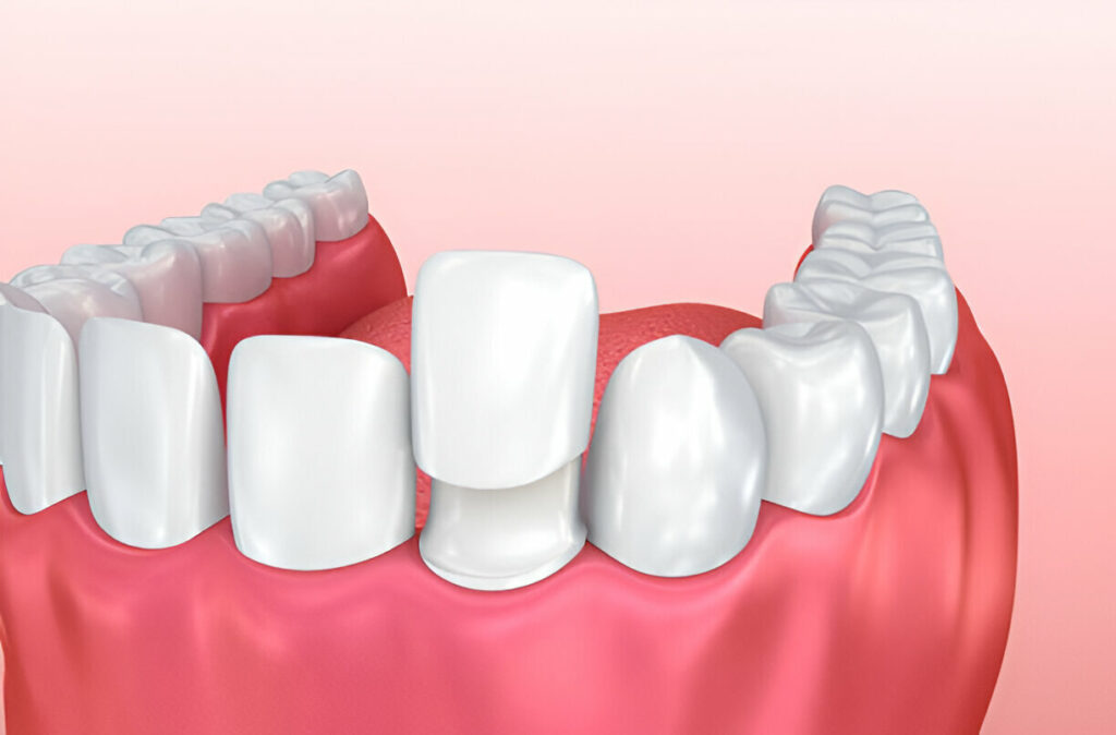 Porcelain Veneers: Everything You Need to Know for a Perfect Smile_2