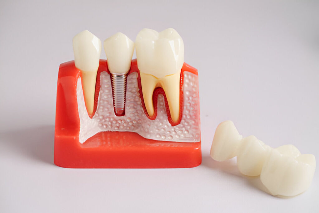 What You Need to Know About Tooth Replacement After Tooth Loss_1