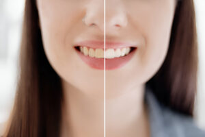 Discover Professional Teeth Whitening in Garland, TX at North Texas Family & Cosmetic Dentistry_FI